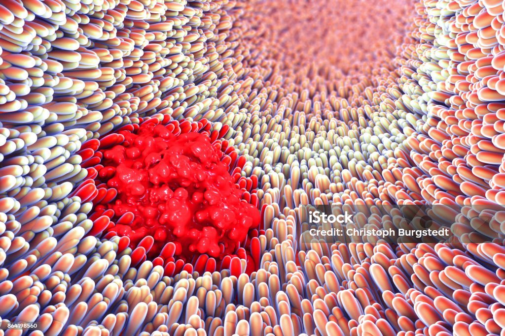 3d illustration of microscopic closeup of intestine villus and s 3d illustration of microscopic closeup of intestine villus and stomach ulcer Abdomen Stock Photo