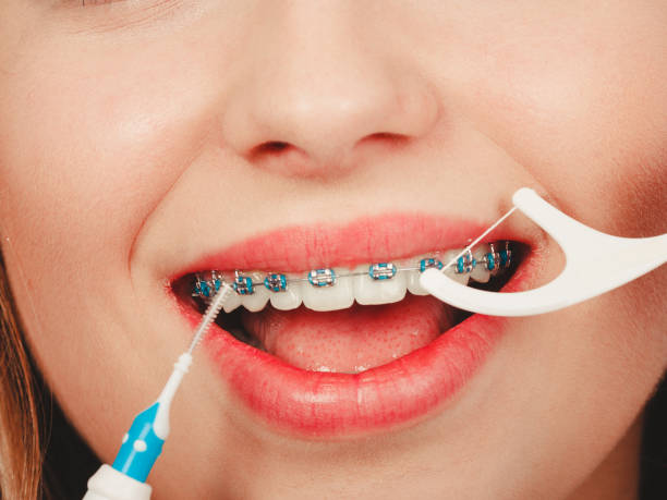 istock Woman smiling cleaning teeth with braces 864407626