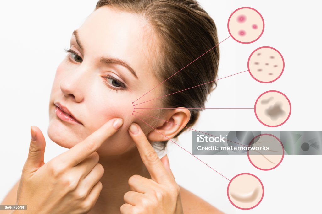 woman skin trouble. pimple, freckle, spot, wrinkle, saggy. Skin Stock Photo