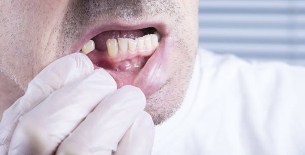 closeup teeth, dental health care clinic with missing tooth - toothless grin imagens e fotografias de stock