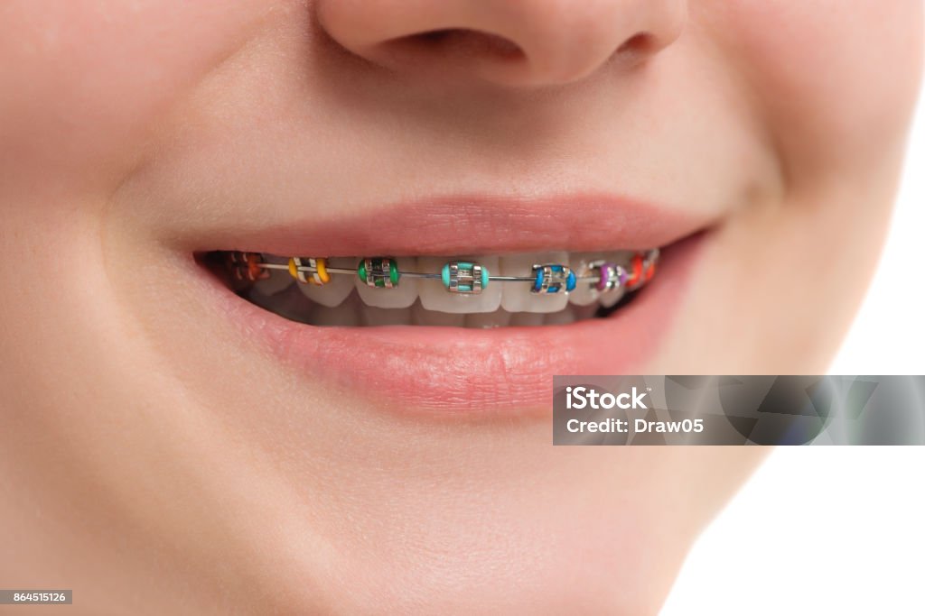 Primer plano multicoloras brackets en los dientes. Hermosa mujer sonrisa con brackets de auto-ligado. Tratamiento de ortodoncia. - Foto de stock de Banda correctora libre de derechos