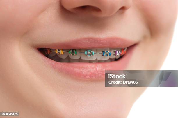 Primer Plano Multicoloras Brackets En Los Dientes Hermosa Mujer Sonrisa Con Brackets De Autoligado Tratamiento De Ortodoncia Foto de stock y más banco de imágenes de Banda correctora