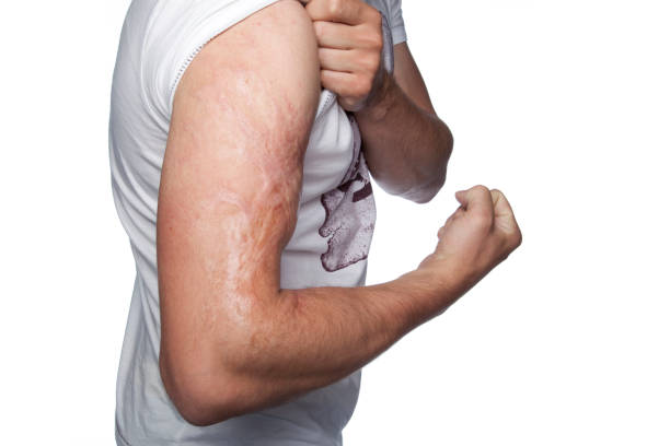 istock scar on his forearm, scalding with boiling water 864532490