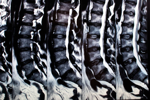 Magnetic resonance with two vertebrae abnormalities. Backbone MRI Magnetic resonance imaging for back pain protrusion stock photo