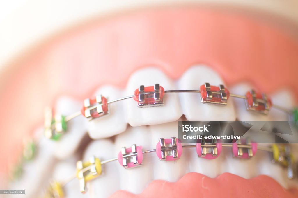 Cosmetic dentistry orthodontics dental metal wire teeth brackets teaching student model. Dental Braces Stock Photo