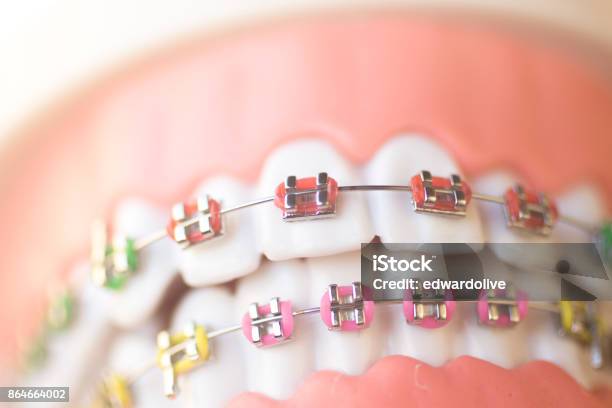 Cosmetic Dentistry Orthodontics Dental Metal Wire Teeth Brackets Teaching Student Model Stock Photo - Download Image Now