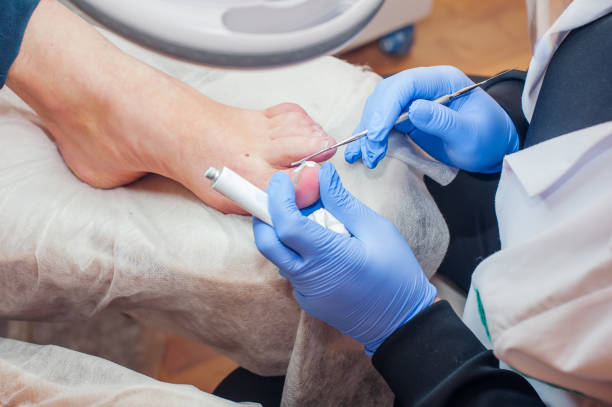 podology treatment. podiatrist treating toenail fungus. doctor removes calluses, corns and treats ingrown nail. hardware manicure. health, body care concept. selective focus - fungus toenail human foot onychomycosis imagens e fotografias de stock