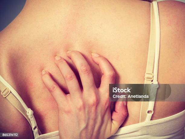 Woman Scratching Her Itchy Back With Allergy Rash Stock Photo - Download  Image Now - Back, Women, Acne - iStock