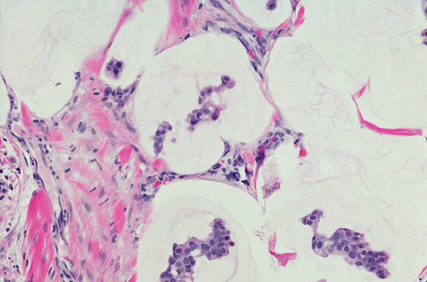 istock Primary mucinous eccrine adenocarcinoma of skin. H&E Stain 865421864