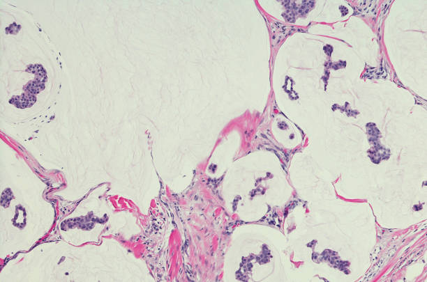 istock Primary mucinous eccrine adenocarcinoma of skin. H&E Stain 865421922