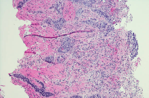 Squamous cell carcinoma of the esophagus. H&E stain Squamous cell carcinoma of the esophagus.  Hematoxylin and eosin staining squamous cell carcinoma photos stock pictures, royalty-free photos & images