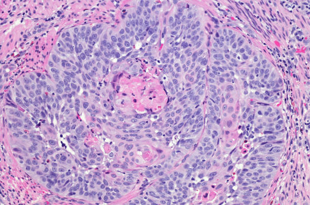 Squamous cell carcinoma of the esophagus. H&E stain Squamous cell carcinoma of the esophagus.  Hematoxylin and eosin staining squamous cell carcinoma photos stock pictures, royalty-free photos & images