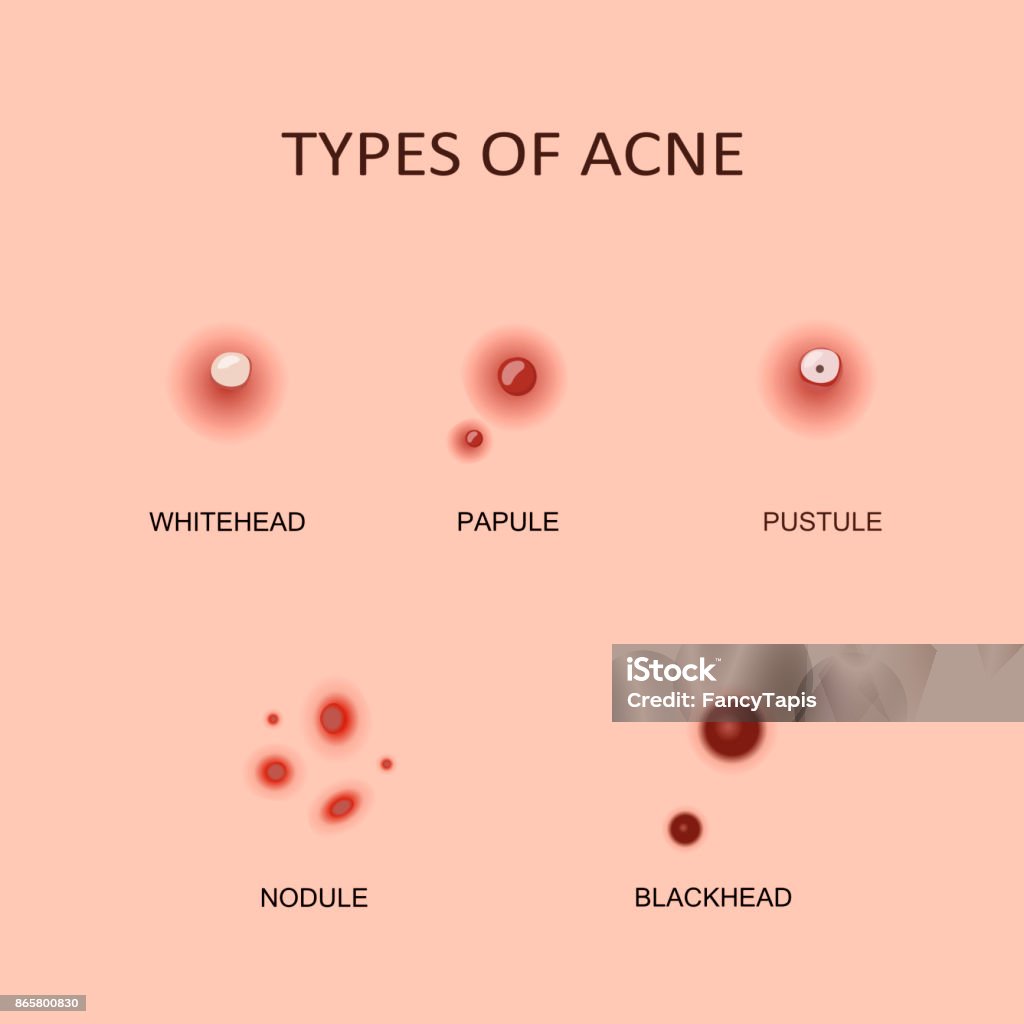 Soorten Acne En Puistjes Stockvectorkunst En Meer Beelden Van Puist soorten-acne-en-puistjes-stockvectorkunst-en-meer-beelden-van-puist