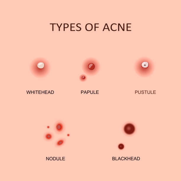 Junior menigte lid Types Of Acne And Pimples Stock Illustration - Download Image Now - Pimple,  Acne, Vector - iStock