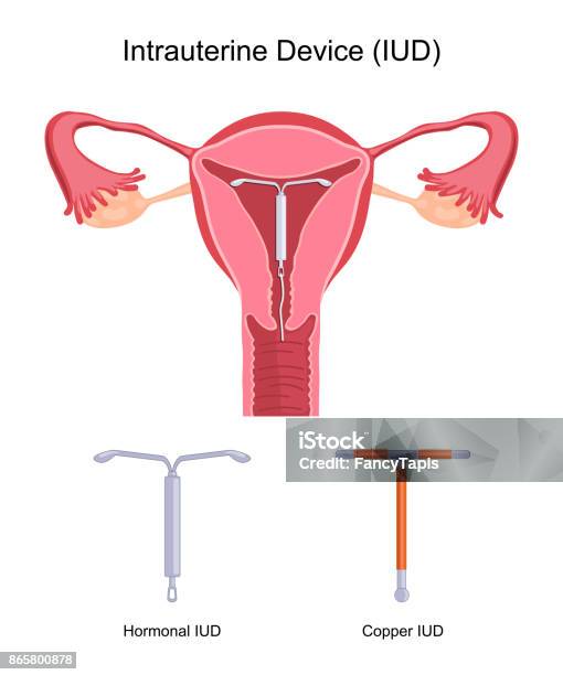 Dispositif Intrautérin Diu Vecteurs libres de droits et plus d'images vectorielles de Stérilet - Stérilet, Contraceptif, Cuivre - En métal