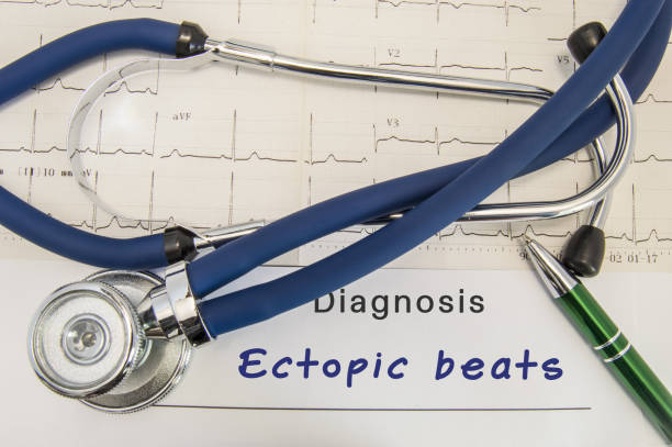 istock Diagnosis of Ectopic beats. Stethoscope and recorded electrocardiogram  on paper lying horizontally inscription diagnosis Ectopic beats on desk in office of cardiologist 865890388