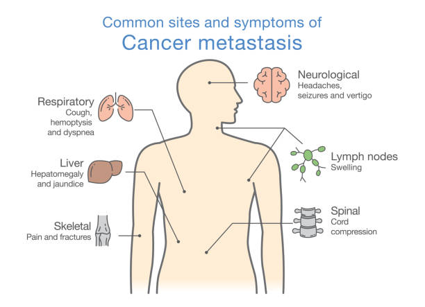 наиболее распространенные сайты и симптомы метастазирования рака. - physical checkup stock illustrations