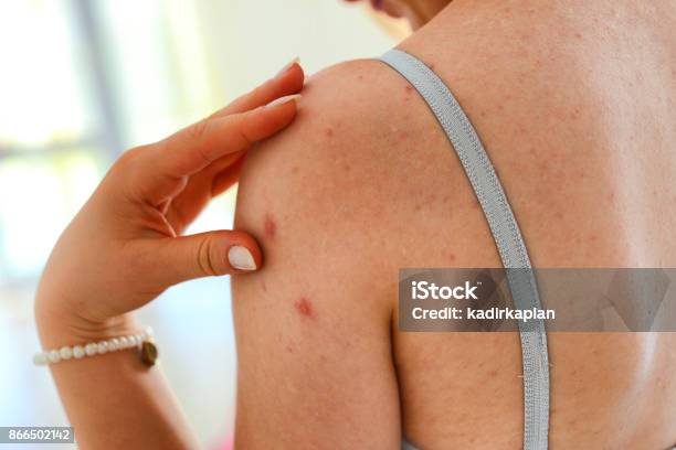 Eczema Stock Photo - Download Image Now - Acne, The Human Body, Shingles