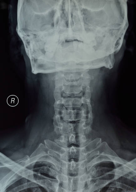 istock X-ray of cervical vertebra photos 866612732