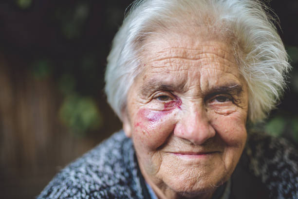 istock Old senior have a bruise under eye after falling 867026834