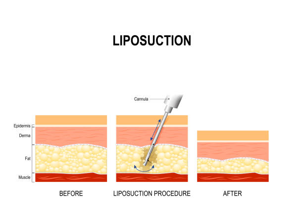 illustrazioni stock, clip art, cartoni animati e icone di tendenza di procedura di liposuzione. - fat layer