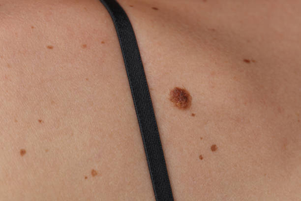 istock Checking benign moles, birthmarks on female back close up. 867129426
