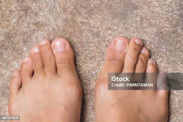 Foot Rheumatoid Foot Disease Background Stock Photo - Download Image Now - Adult, Antibiotic, Arm