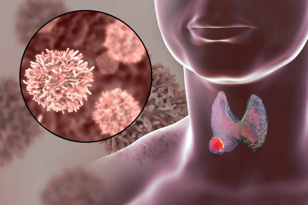Thyroid cancer illustration stock photo