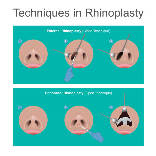 ilustrações, clipart, desenhos animados e ícones de técnicas em rinoplastia. - nose job illustrations