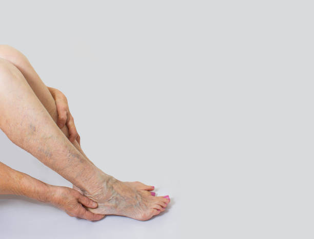 istock Varicose veins on a female legs 867848606