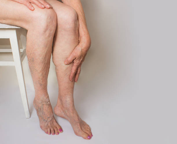 Varicose veins on a female legs The varicose veins on a legs of old woman on gray blood clot photos stock pictures, royalty-free photos & images