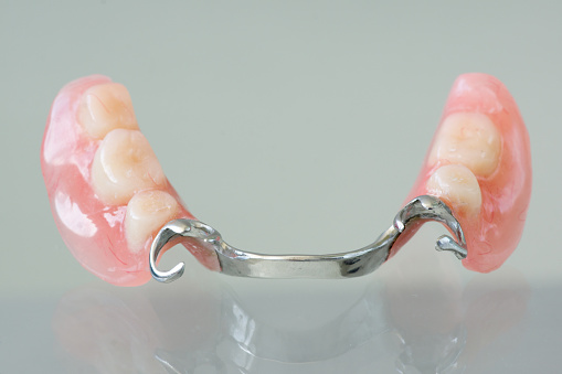 Clasp denture with a metal arc and artificial teeth