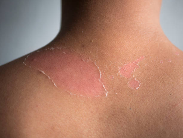 peeling skin at back and shoulder from sunburn effect on body of young man from sunbath at summer. dangerous sunburn concept peeling skin at back and shoulder from sunburn effect on body of young man from sunbath at summer. dangerous sunburn concept tan skin stock pictures, royalty-free photos & images