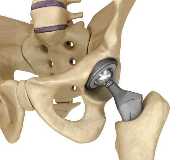 힙합 교체 이식 골반 뼈에 설치입니다. 의학적으로 정확한 3d 그림 - hip replacement 뉴스 사진 이미지