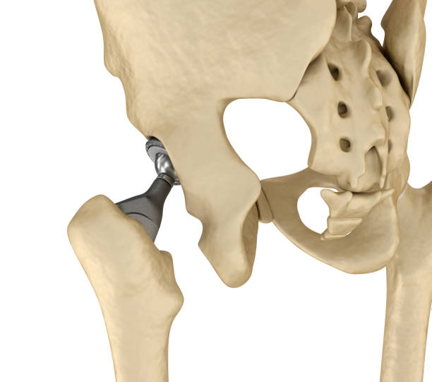 istock Hip replacement implant installed in the pelvis bone. Medically accurate 3D illustration 868425374