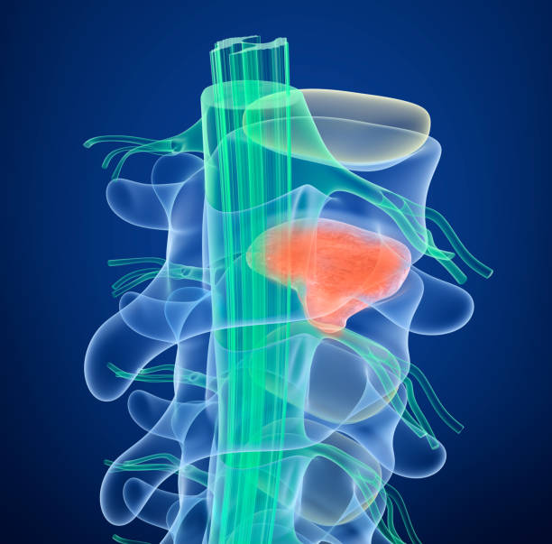 istock Spinal cord under pressure of bulging disc, 3D illustration 868425492