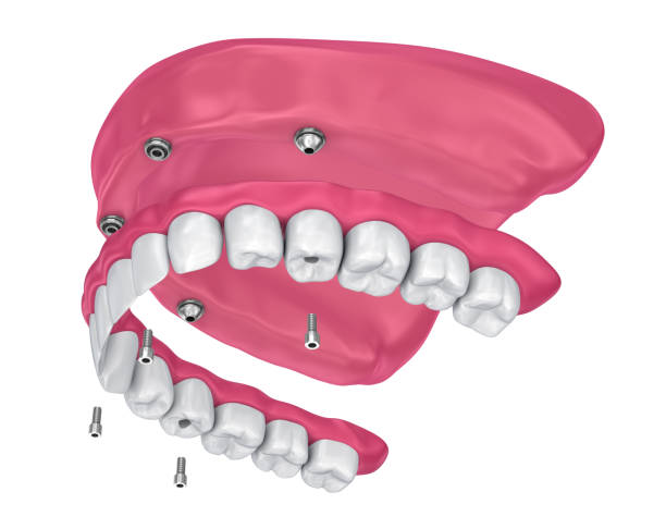 Overdenture to be seated on implants attachments. 3D illustration Overdenture to be seated on implants attachments. 3D illustration boreray and stac lee stock pictures, royalty-free photos & images