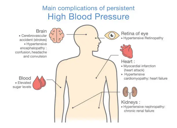 Vector illustration of Main complications of persistent High Blood Pressure.