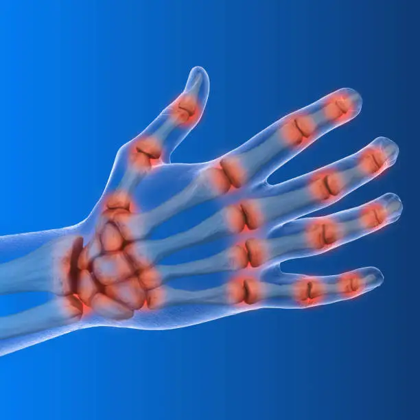 3d illustration showing arthritis of the hand