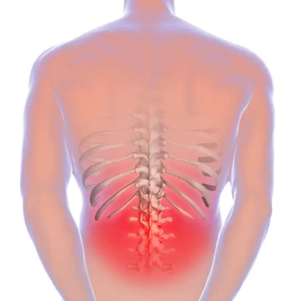 Photo of 3d illustration of sciatica causing lower back pain