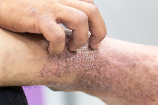 Dermatitis atópica (AD), también conocida como eccema atópico, es un tipo de inflamación de la piel (dermatitis) en pie. photo