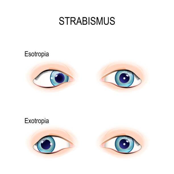 Ilustración de Estrabismo Ojos Bizcos y más Vectores Libres de Derechos de Ojo - Ojo, Anatomía, Asistencia sanitaria y medicina - iStock Ilustración de Estrabismo Ojos Bizcos y más Vectores Libres de Derechos de Ojo - Ojo, Anatomía, Asistencia sanitaria y medicina - iStock