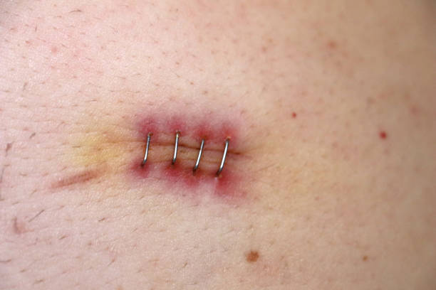 istock scar of an appendicitis operation 869245908