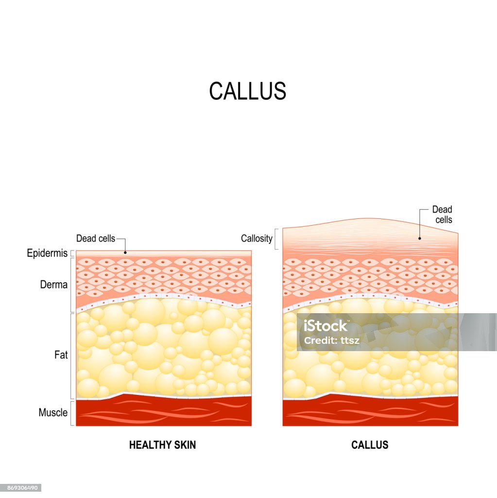 Callused Body Callus Stock Illustration - Download Image Now - Anatomy, Barefoot ...