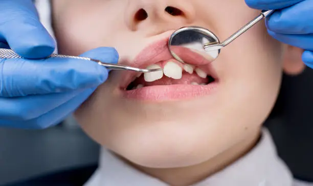 Close-up of dentist's hand examining teeth of boy patient in dental clinic using dental tools - probe and mirror. Dentistry