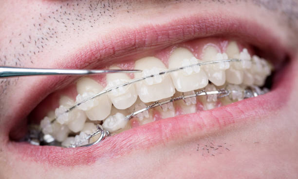 istock Dentist checking up teeth with ceramic brackets using probe at the dental office. Macro shot of teeth with braces. Orthodontic Treatment. Dentistry 869320712