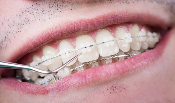 istock Dentist checking up teeth with ceramic brackets using probe at the dental office. Macro shot of teeth with braces. Orthodontic Treatment. Dentistry 869320762