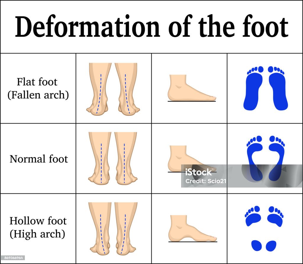 Deformation of the foot Illustration of the deformation of the foot - flat feet and a hollow foot. There are footprints, the form of the foot on the side and behind Foot stock vector