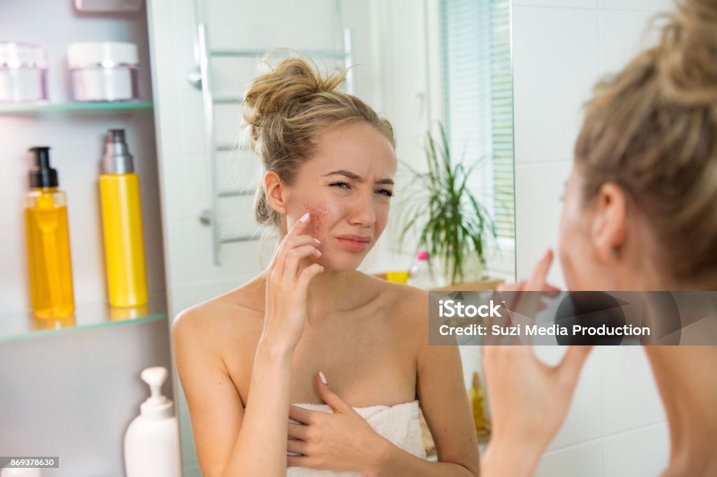 Belle jeune femme avec sèche sur la peau irritée. - Photo de Peau acnéique libre de droits