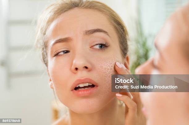 Young Beautiful Woman With Dry Irritated Skin Stock Photo - Download Image Now - Skin, Dry, Human Skin